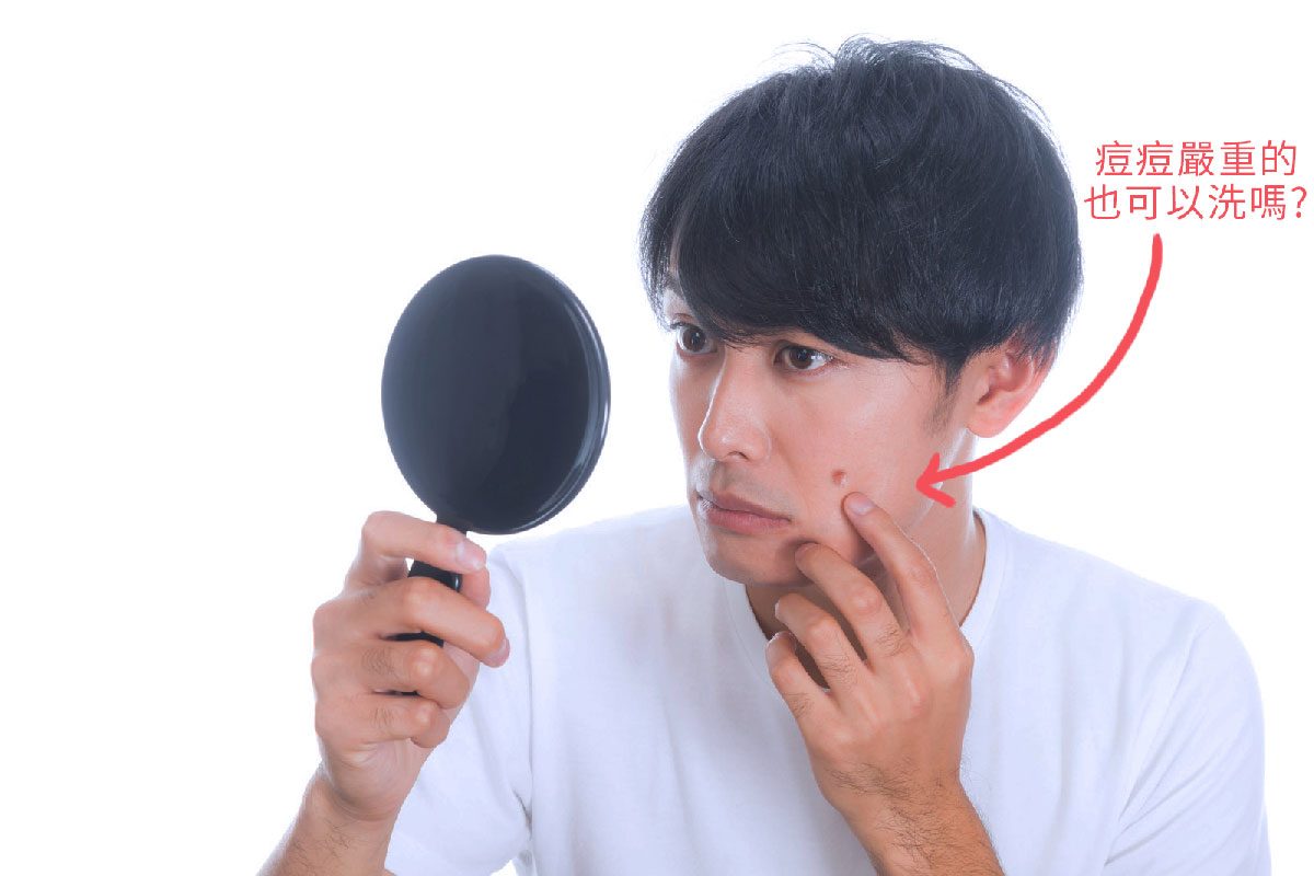 痘痘嚴重的也可以洗嗎?