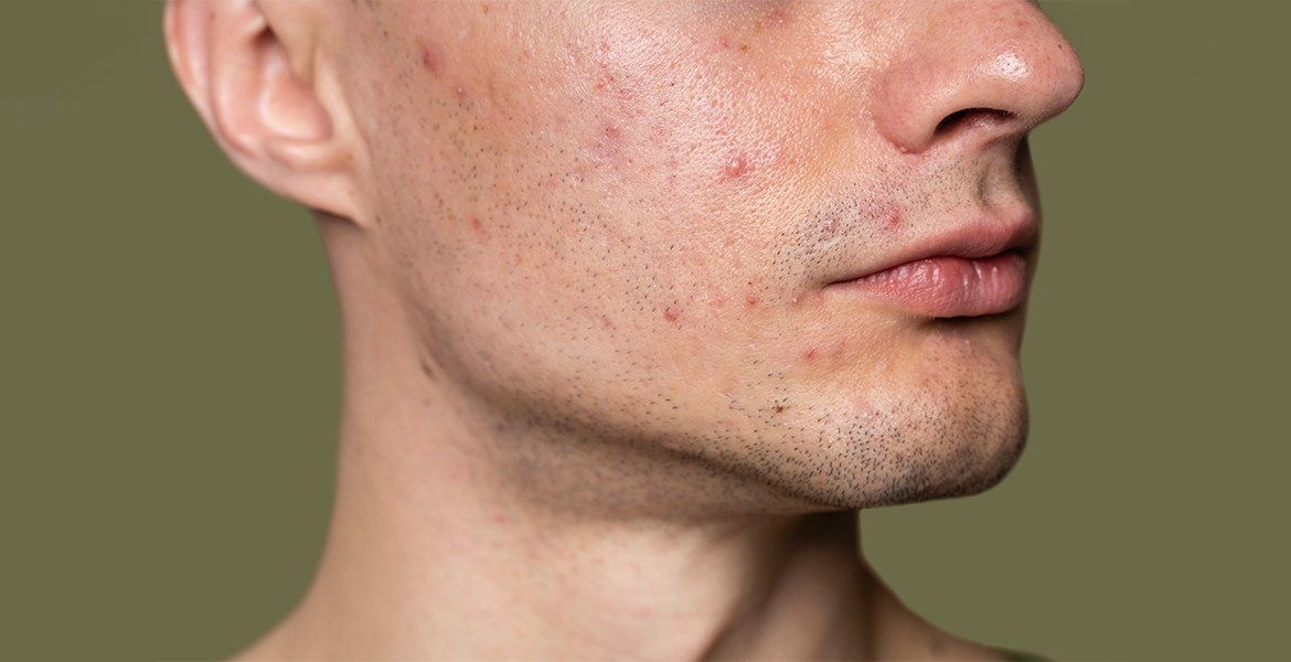 油性肌膚的特性